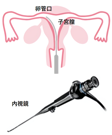 子宮鏡検査・子宮鏡下選択的卵管通水法