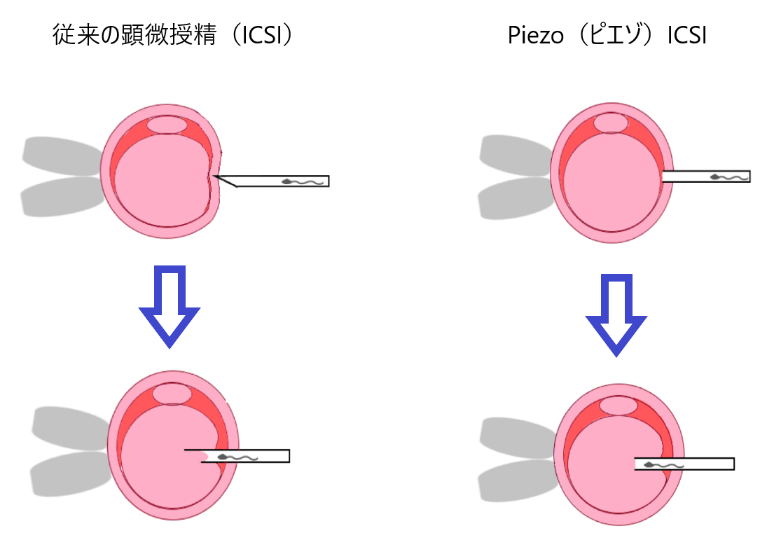 icsi とは